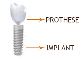 Implant et sa prothèse